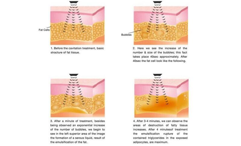 Cavitation