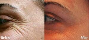 Facial Muscle Relaxants