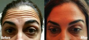 Facial Muscle Relaxants