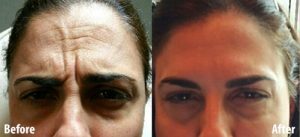 Facial Muscle Relaxants