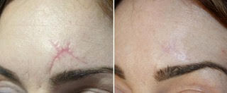 Fibroblast Skin Tightening
