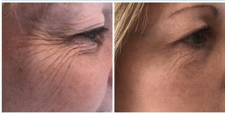 Fibroblast Skin Tightening