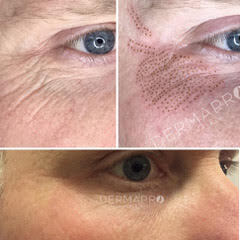 Fibroblast Skin Tightening