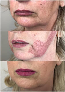 Fibroblast Skin Tightening