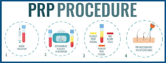 Platelet Rich Plasma Fillers