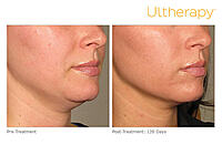 Ultherapy