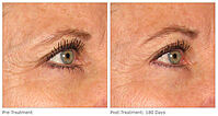 Ultherapy